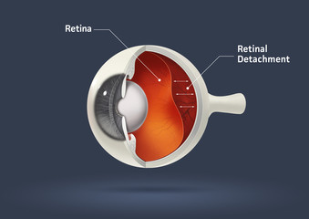 Retinal detachment