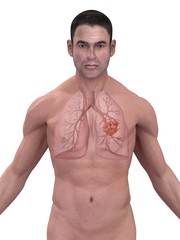 Fototapeta premium lungenkrebs