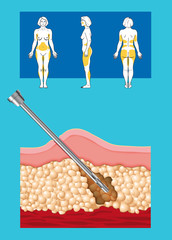 liposuction