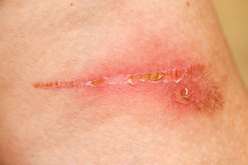 Fototapeta premium A burn scar that is partly healed