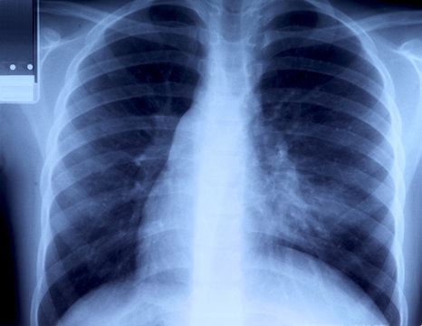 radiography of chest