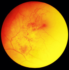 Eye under microscope examination - ischemic haemorrhage - obrazy, fototapety, plakaty