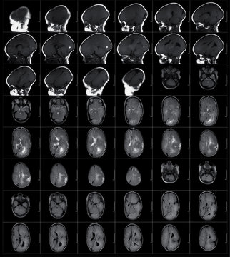 MRI human head scan