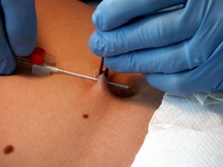 Durchstechen des Bauchnabels (Piercing)