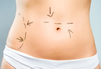Drawn abdomen for plastic surgery
