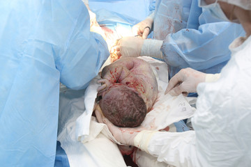 New baby being born during cesarean section - obrazy, fototapety, plakaty