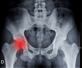 douleur au col du femur