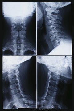 entorse des vert&egrave;bres cervicales