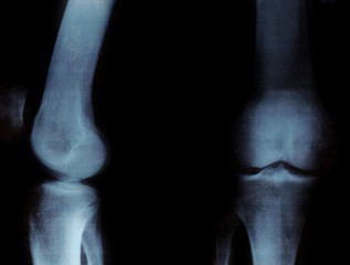 X-ray of the knee-joints