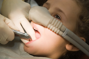 dentist pulling out a tooth of child