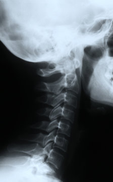 X ray of a neck
