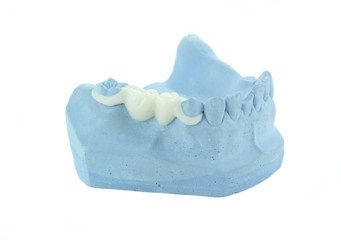 Thermoflex - A unilater partial bridge