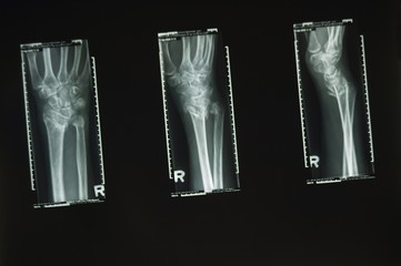 Three x-rays of a wrist