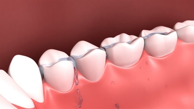 Cleaning Teeth
