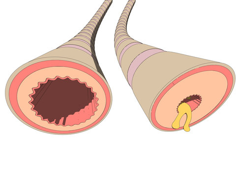 Asthma Bronchiales