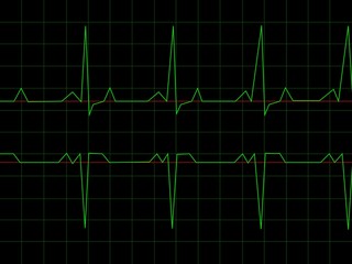 Normal Heart Rhythm