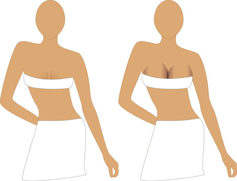 Before and After Breast Augmentation Implants.