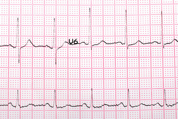 EKG printout