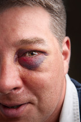 Black eye portrait
