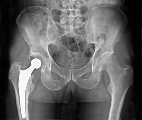 Radiographie Prothèse totale de hanche