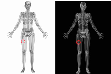 Anatomischer Körper mit gebrochenem Femur (Knochen)