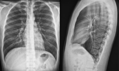 Chest X-Ray