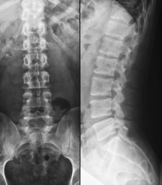 Lumbar spine with slight s-shaped skoliosis