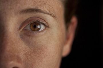 Freckle Face