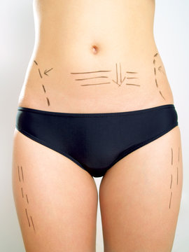 Abdomen, waist, thigh marked for plastic surgery