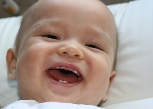 Baby bilder zahndurchbruch Crouzon Syndrome: