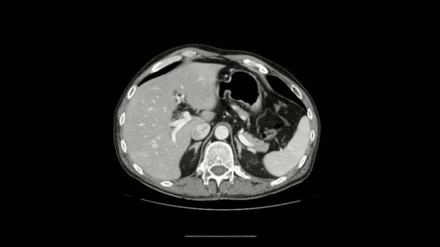 Radiology - abdominal ct scan