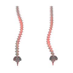 thoracic and lumbar scoliosis