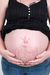 Stretch Marks
