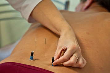 acupuncture