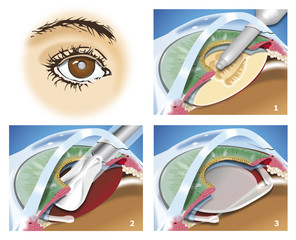 cataract - obrazy, fototapety, plakaty