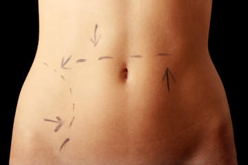 Caucasian woman's abdomen marked with lines