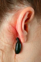 Blood sucking leech on head.