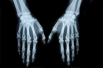 Röntgenbild zehn Finger Frauenhand