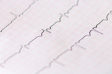 electrocardiogram