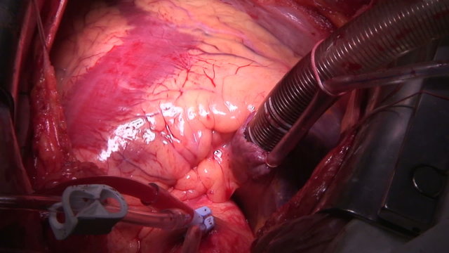 Cardiac surgery. Beating Heart.