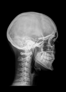 röntgenbild kopf