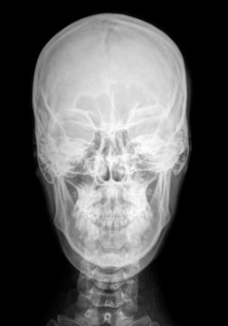 röntgenbild kopf frontal