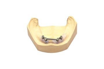 Dental Implantate Steg