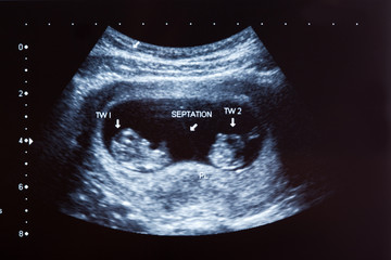 Ultrasound scan of 10 months old twins - obrazy, fototapety, plakaty