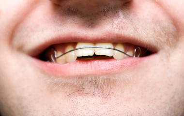 Fototapeta premium male with overbite wearing braces and smiling