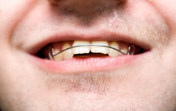 Male With Overbite Wearing Braces And Smiling