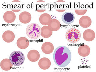 Smear of peripheral blood