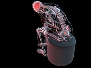 Kopfschmerzattacke - menschliches Skelett