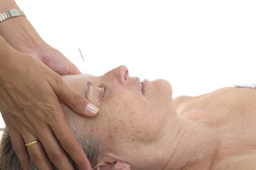 Acupuncture