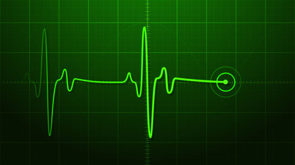 EKG - Electrocardiogram